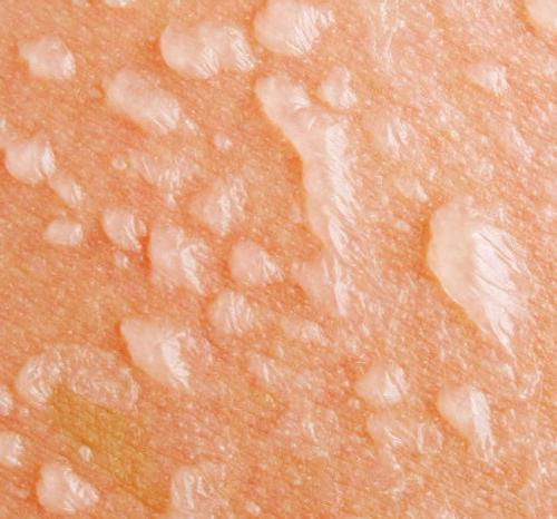 Солнечный ожог с волдырями