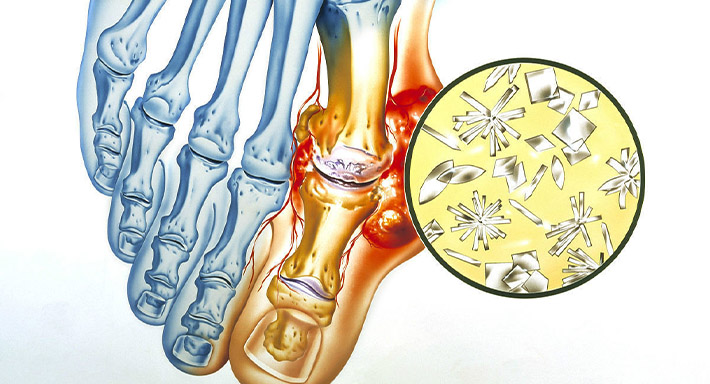 Как правильно лечиться от подагры
