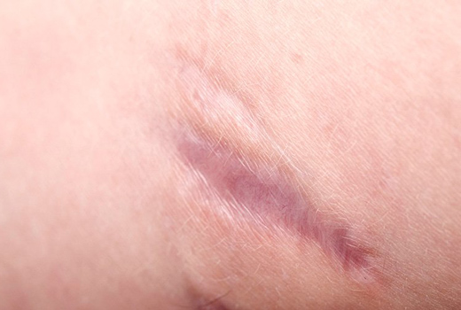 Что может помочь от шрамов от ожога Что может помочь от шрамов от ожога thumbnail