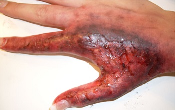 Сильный ожог руки