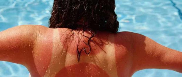 solnechniy-ozhog Солнечный ожог