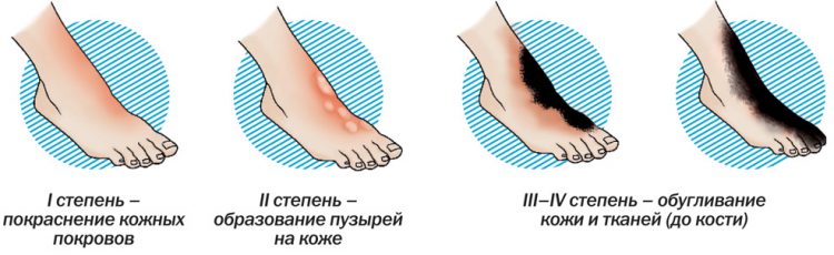 Ожог горячей водой с волдырем как лечить