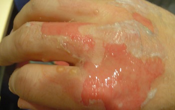 Термическая рана