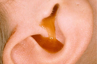 Оторея Острый средний отит