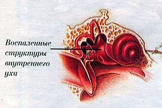 Внутренний отит Внутренний отит