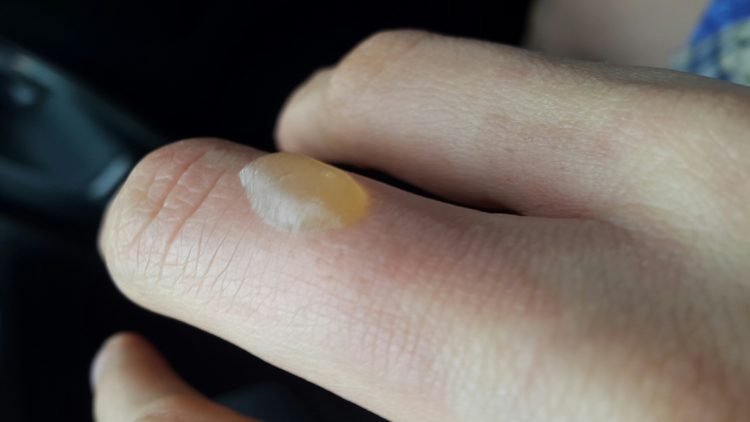 Как быстро убрать волдыри после ожога