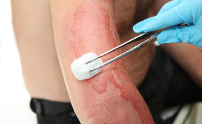 Заживление ожога 2 степени Заживление ожога 2 степени