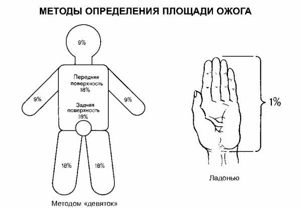 Площадь ожога по схеме Площадь ожога по схеме