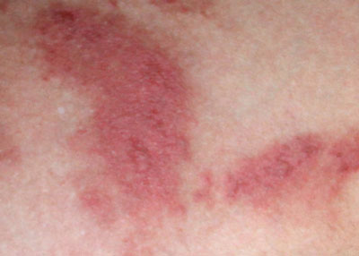Красные высыпания Почему появляются красные пятна похожие на ожоги